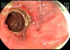 Anastomosis Colo-Colo termino terminal